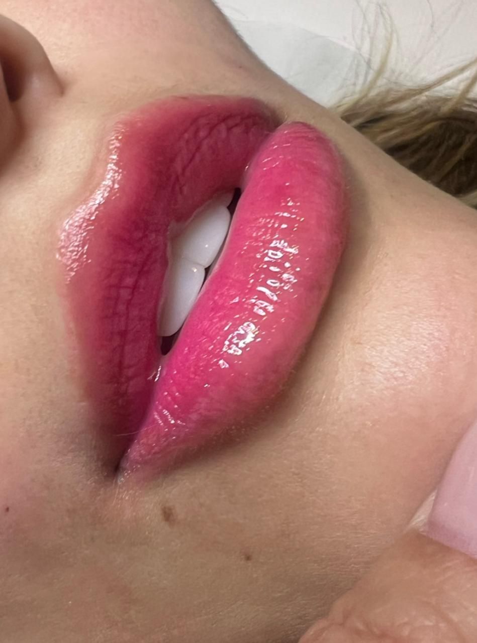 Preenchimento labial realizado por Jaina Fonseca (1)